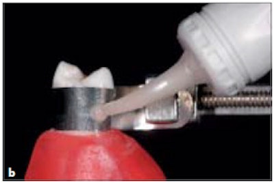 With The Matrix Band Tightly Fit At The Cervical Margin, Palatal/Lingual Access Is Allowed Through An Opening And Glass Ionomer Injected Into The Preparation