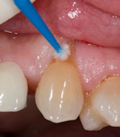 Futurabond DC is a nano-reinforced, dual-cured, one-step self-etch adhesive.