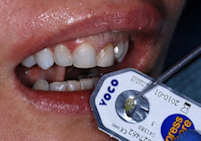 Voco America's Futurabond DC blister foil pack is easy to use.