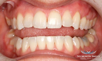 Before and after images of a Six Month Smile case.