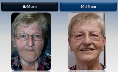 Larell One Step Dentures can be fabricated in about an hour and retail for $1,200