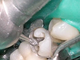 A football finishing bur is used to create a window in the band