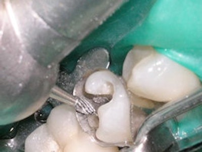 A football finishing bur is used to create a window in the band