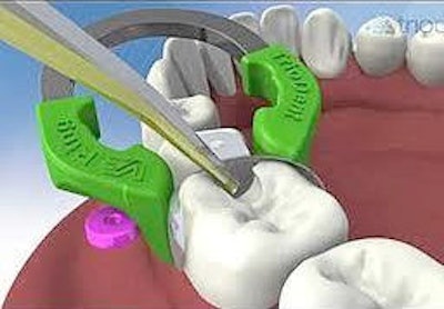 The Triodent V3 Matrix Band and Ring