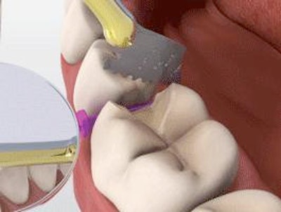After cavity prep, the guard is detached while the wedge stays in place