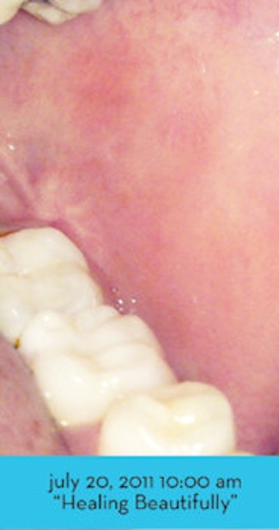 Cheek bite images from an internal study show the injury's progression with the aid of the patch.