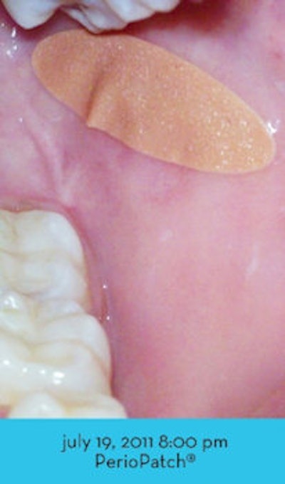 2011 10 18 10 52 52 564 Perio Patch2