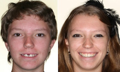 Patient before and after orthodontic treatment provided by Dr. Montano