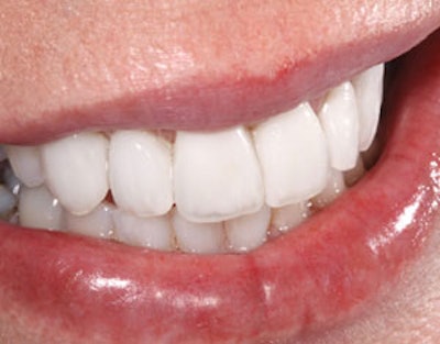 Left: A straightforward image of a patient's smile. Right: A 'glamorized' version of the same smile. All images courtesy of Dr. James Dunn.