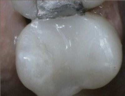 A SonicFill restoration that was filled in a single increment, light-cured, and polished.