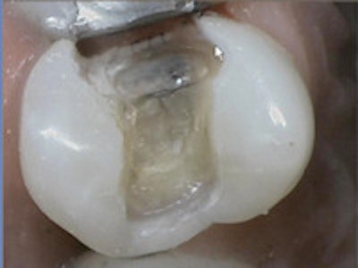 SonicFill restoration