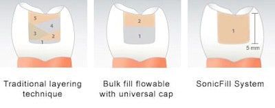 SonicFill is a sonic-activated, bulk fill dental composite system for posterior restorations that requires no additional capping layer.