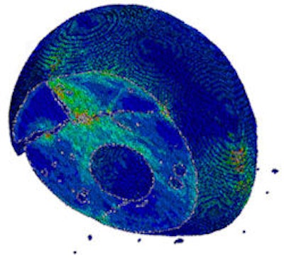 Researchers involved in the EU BIO-CT-EXPLOIT project used finite element analysis to enhance a software prototype that allows a dentist to perform patient-specific simulations of an implant. Image courtesy of Vienna University of Technology.