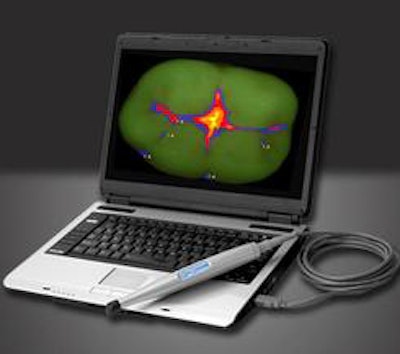 Spectra optical caries detection device can image the entire spectrum of caries severity, from enamel demineralization to dentin decay. Image courtesy of Air Techniques.