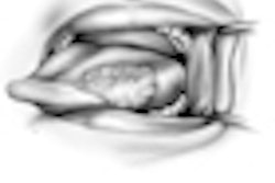 2012 03 20 15 26 16 33 Tongue Cancer 70