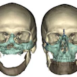 2012 03 28 10 14 48 584 Face Transplant 350