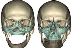 2012 03 28 10 14 48 584 Face Transplant 350