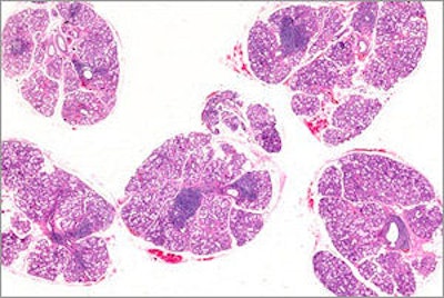 Photomicrograph of a salivary gland with sites of inflammation indicative of Sjögren's syndrome. Image courtesy of NIDCR.