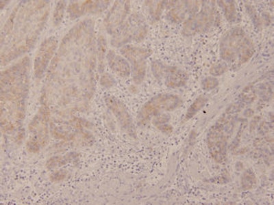 In stage T3, carcinoma cells invade the muscle layer of the tongue; these cells have a strong positive reaction for the MUC1 glycoprotein. Image courtesy of Rie Kawashima, Jichi Medical University.
