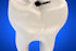 2009 05 06 09 41 49 364 Tooth Caries 70