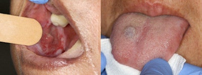 Suspicious lesions found in patients during an oral cancer screening in September. Images courtesy of Texas Academy of General Dentistry.