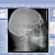 2012 06 05 09 17 23 69 Planmeca Romexis Cephalometric Analysis Thumb