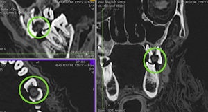 Multiplanar Reformatted Ct Slices Showing The Packing Material In The Large Interproximal Carious Lesion