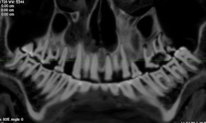 Curved Planar Reformatted Ct Image