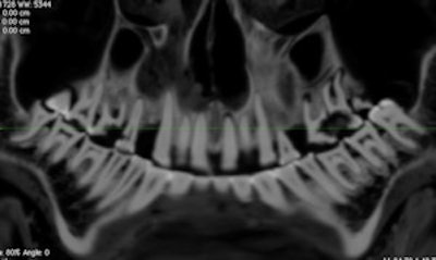 Curved Planar Reformatted Ct Image