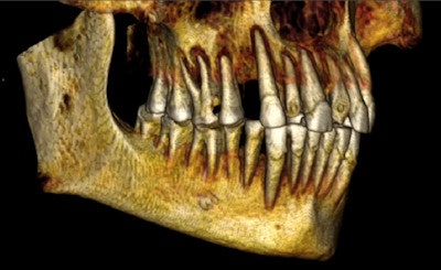Multiplanar Reformatted Ct Slices Showing The Packing Material In The Large Interproximal Carious Lesion