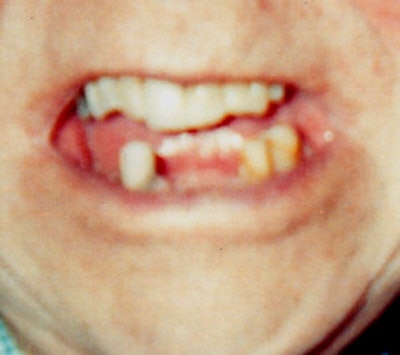 Hank Grass is fighting Medicare to get coverage for dentures and oral surgeries, but Medicare has refused, saying the procedures are cosmetic.