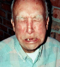After Hank Grass developed submandibular cancer, radiation therapy caused osteoradionecrosis, requiring the extraction of all but three of his bottom teeth. All images courtesy of Hank Grass.