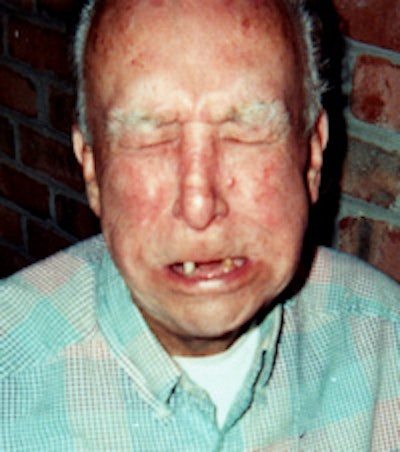 After Hank Grass developed submandibular cancer, radiation therapy caused osteoradionecrosis, requiring the extraction of all but three of his bottom teeth. All images courtesy of Hank Grass.