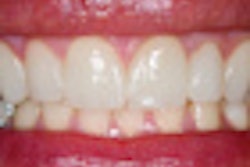 2012 11 09 15 45 34 449 Teeth Veneers 70