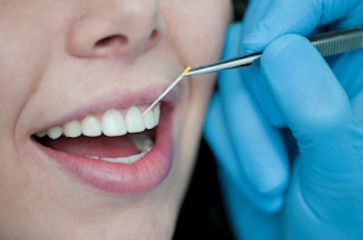 With ParoChip, sterile, toothpick-shaped paper points are used to remove bacteria from the teeth for analysis using a method based on the polymerase chain reaction. Image courtesy of Fraunhofer Institute for Cell Therapy and Immunology.
