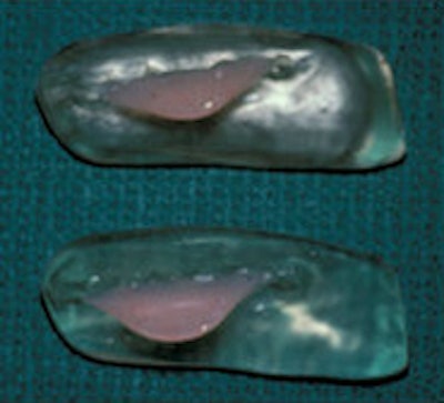 Above: Intraoral radiation shields prevent the tongue and nearby oral areas from getting irradiated while minimizing mucositis and xerostomia. Below: The surgical obturator is a prosthetic device that enables patients to speak and swallow following surgery for maxillary sinus cancer.