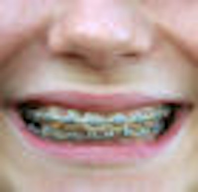 2009 09 17 14 22 39 922 Braces 70