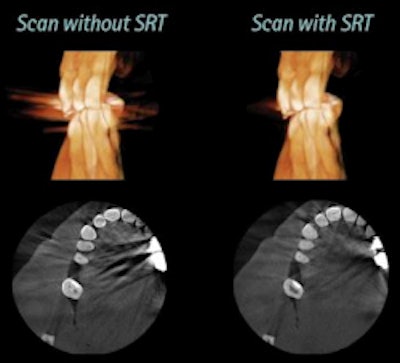 Gendex's scatter reduction technology, a new feature on the GXDP-700 cone-beam CT system, improves image quality and reduces retakes. Image courtesy of Gendex.