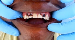 Haitian boy before treatment