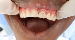 A Haitian boy treated by Dental Care for Children, before and after.