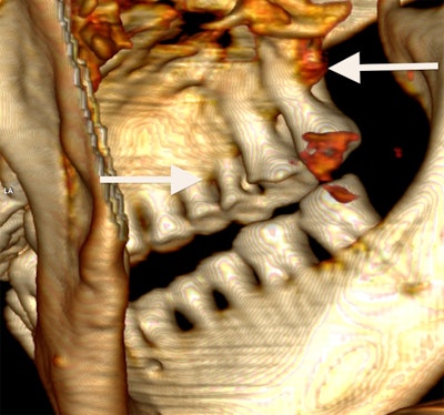 View of the right side of the iceman