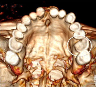 Top view of the iceman