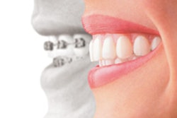 2013 05 07 10 36 39 650 Invisalign 200