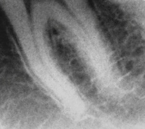Raw image obtained from a dental fluoroscopic imaging system intraoral/extraoral sensor working prototype on a dental phantom at 0.2 mA/0.033-second exposure time.