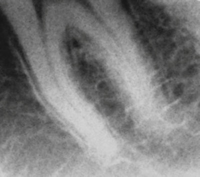 Raw image obtained from a dental fluoroscopic imaging system intraoral/extraoral sensor working prototype on a dental phantom at 0.2 mA/0.033-second exposure time.
