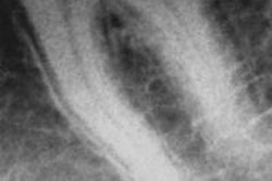 2013 05 21 10 30 36 526 2013 05 22 Fluoroscopy Tooth 20130521173104