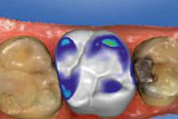 2012 08 17 10 15 19 988 Sirona Omnicam 20130611234529
