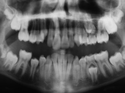 Panoramic radiograph (above) and 3D rendering (below) of MRI data showing a mesiodens in a 12-year-old male patient. Images courtesy of Olga Tymofiyeva, PhD.