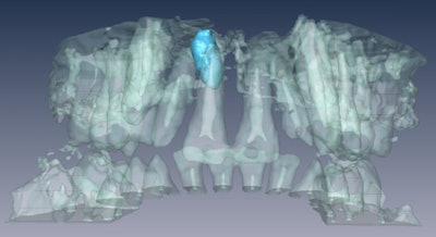 3D rendering of MRI data showing mesiodens in 12-year-old boy