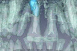 2013 07 05 13 55 36 651 2013 07 08 Mesiodens Mri 200